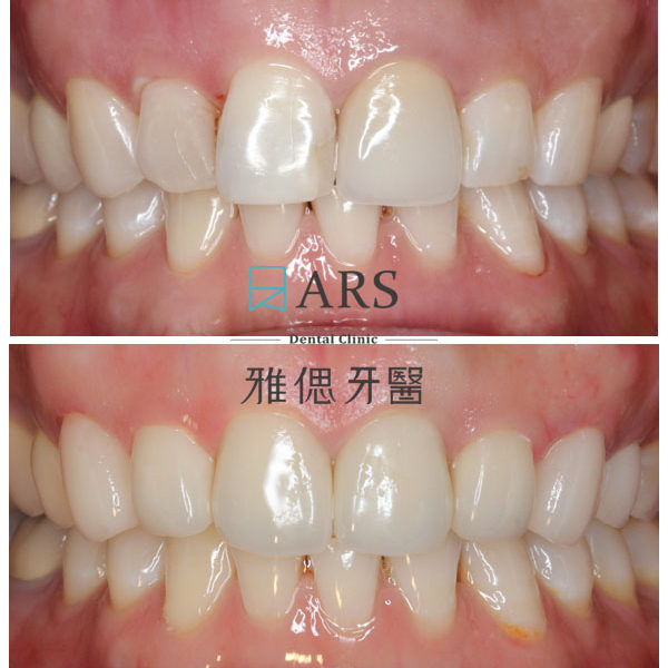 【全瓷冠+陶瓷貼片】 案例5 – 蔡昀蓉醫師