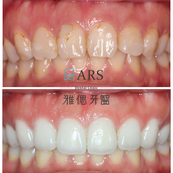 【全瓷冠+陶瓷貼片】 案例6 – 蔡昀蓉醫師