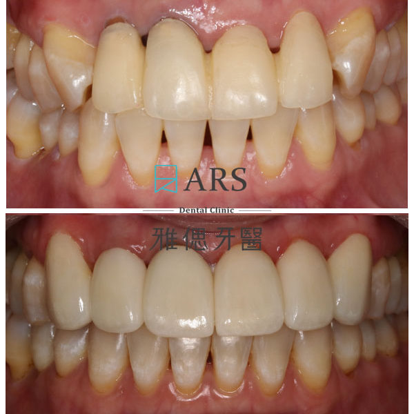 【全瓷冠+陶瓷貼片】 案例6 – 鄭聖達醫師
