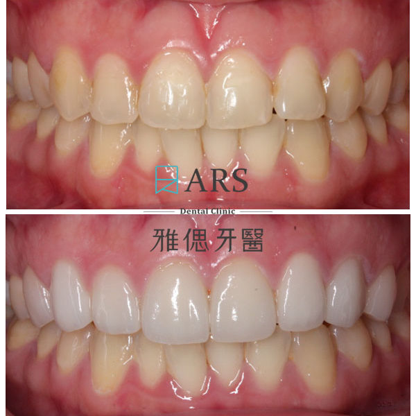 【全瓷冠+陶瓷貼片】 案例7 – 鄭聖達醫師