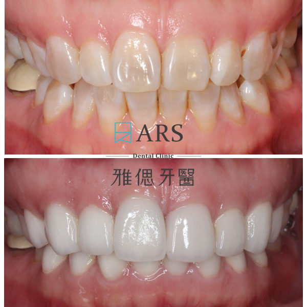 【全瓷冠+陶瓷貼片】 案例7 – 蔡昀蓉醫師