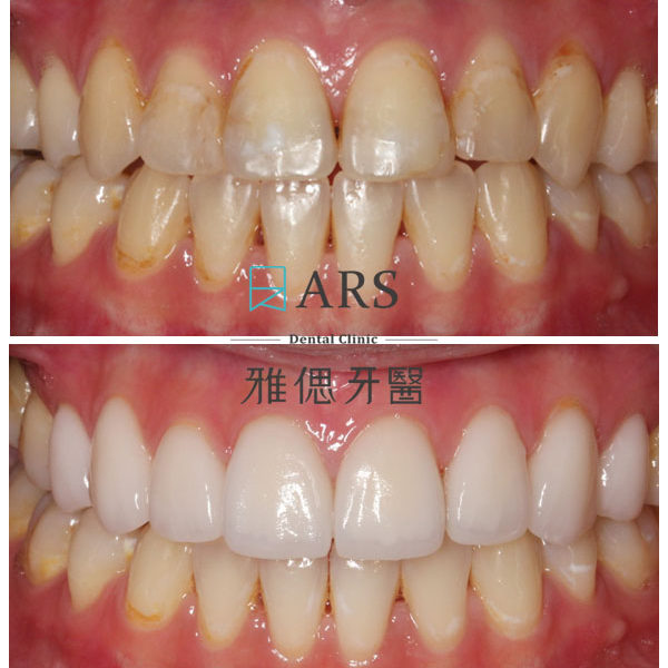 【全瓷冠+陶瓷貼片】 案例8 – 蔡昀蓉醫師