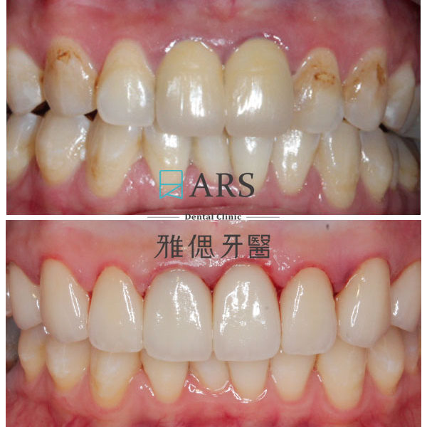 【全瓷冠+陶瓷貼片】 案例8 – 鄭聖達醫師