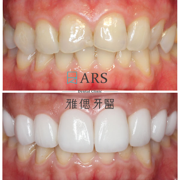 【全瓷冠+陶瓷貼片】 案例9 – 蔡昀蓉醫師