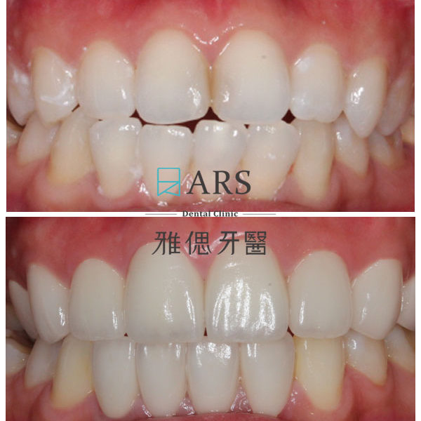 【全瓷冠+陶瓷貼片】 案例9 – 鄭聖達醫師