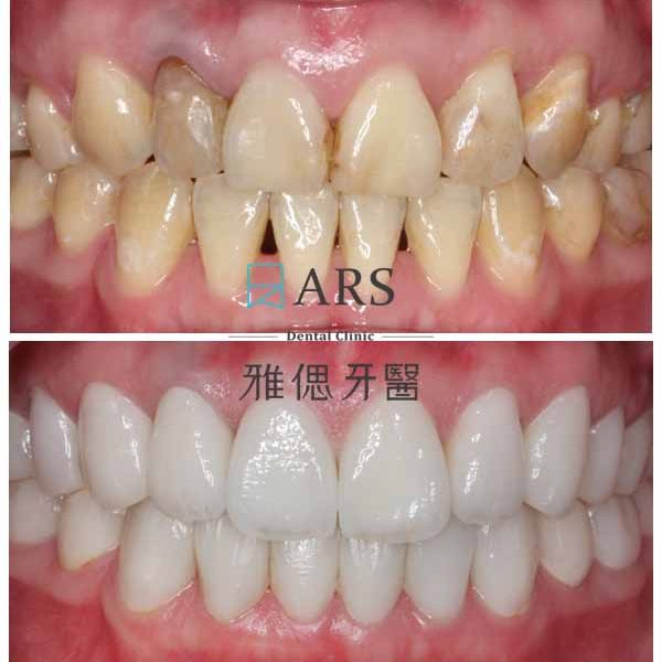 【全瓷冠+陶瓷貼片+水雷射牙冠增長術】 案例1 – 蔡昀蓉醫師
