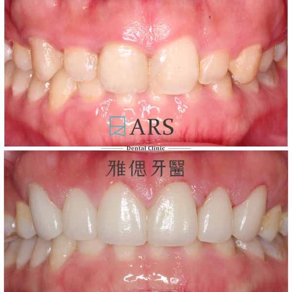 【全瓷冠+陶瓷貼片+水雷射牙冠增長術】 案例1 – 蔡昀蓉醫師、陳映瑜醫師聯合主治