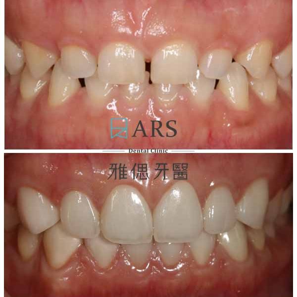 【全瓷冠+陶瓷貼片+水雷射牙冠增長術】 案例1 – 鄭聖達醫師