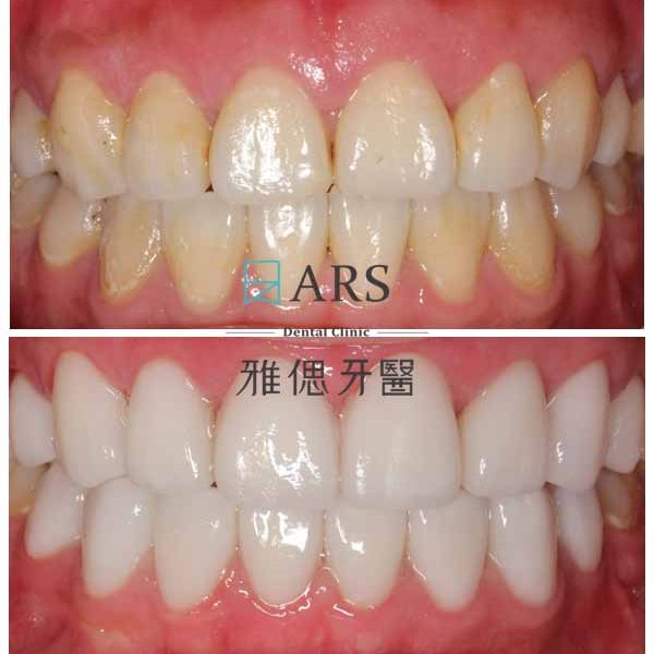 【全瓷冠+陶瓷貼片+水雷射牙冠增長術】 案例1 – 鄭聖達醫師、蔡昀蓉醫師聯合主治