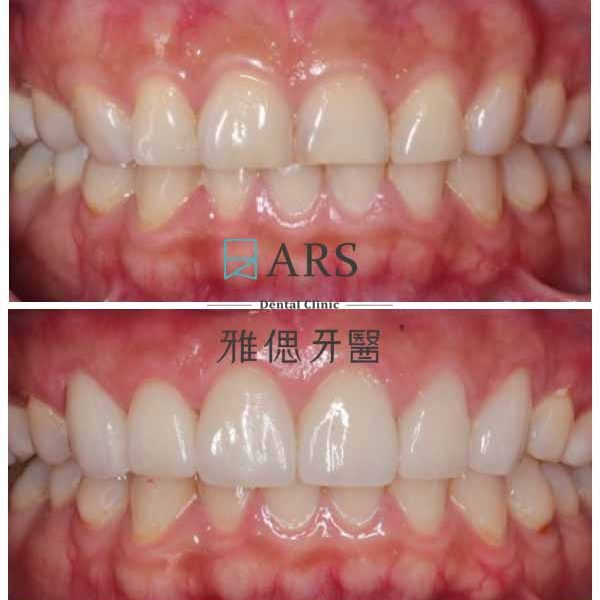 【全瓷冠+陶瓷貼片+水雷射牙冠增長術】 案例2 – 鄭聖達醫師
