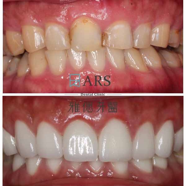 【全瓷冠+陶瓷貼片+水雷射牙冠增長術】 案例3 – 鄭聖達醫師