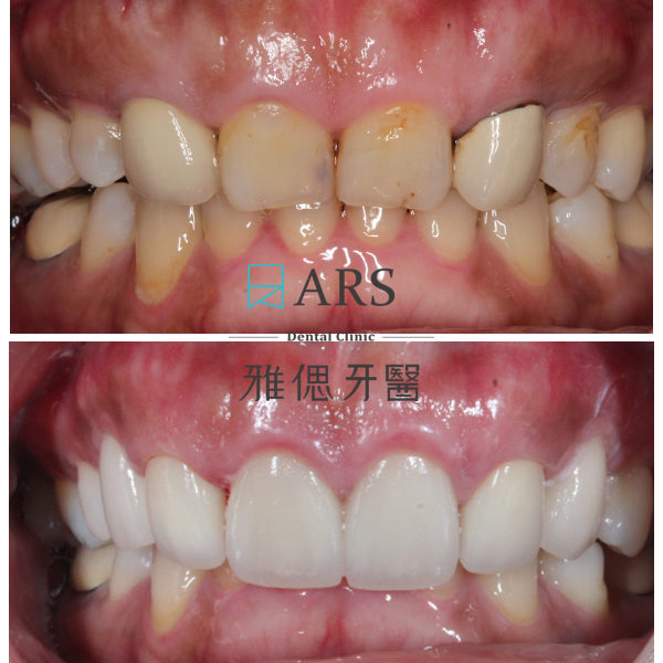 【全瓷冠+陶瓷貼片+水雷射牙冠增長術】 案例4 – 鄭聖達醫師