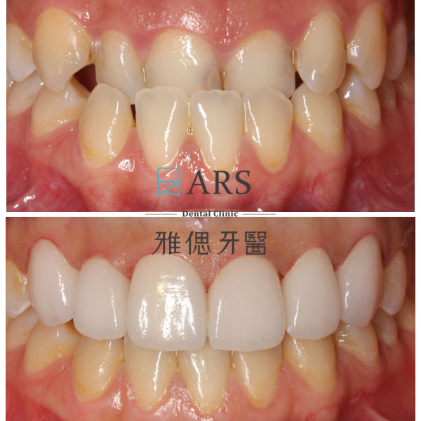 【矯正+全瓷冠+陶瓷貼片】 案例1 – 蔡昀蓉醫師