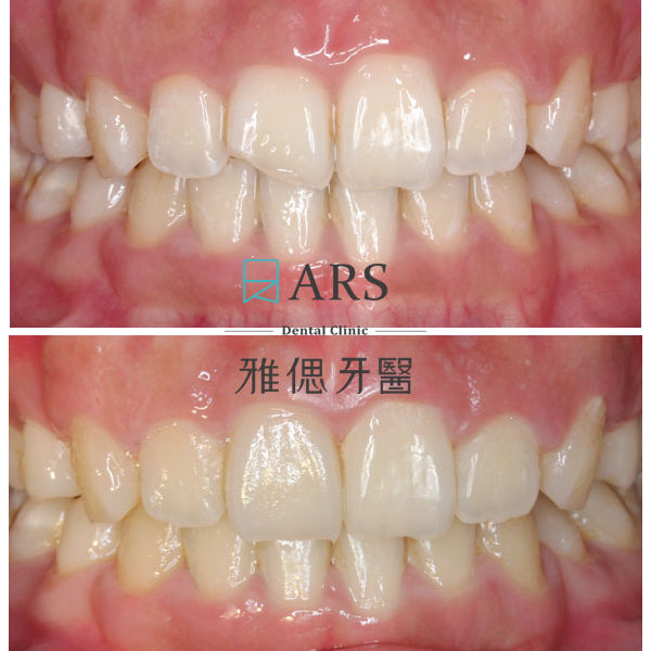 【陶瓷貼片】 案例1 – 蔡昀蓉醫師