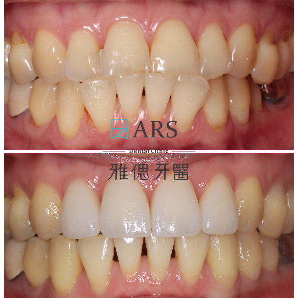 【陶瓷貼片】 案例1 – 鄭聖達醫師