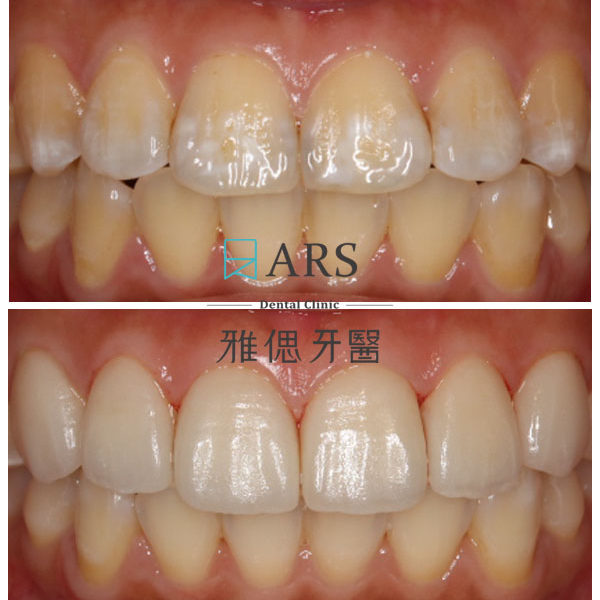 【陶瓷貼片】 案例2 – 鄭聖達醫師