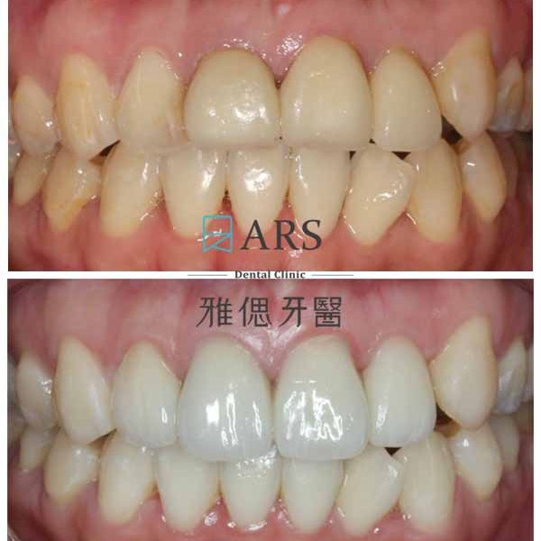 【陶瓷貼片+水雷射牙冠增長術】 案例1 – 蔡昀蓉醫師、陳映瑜醫師聯合主治