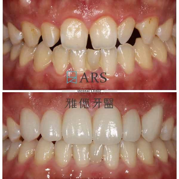 【陶瓷貼片+水雷射牙冠增長術】 案例1 – 鄭聖達醫師