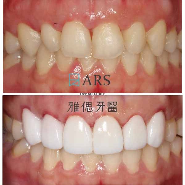 【陶瓷貼片+水雷射牙冠增長術】 案例1 – 鄭聖達醫師、蔡昀蓉醫師聯合主治