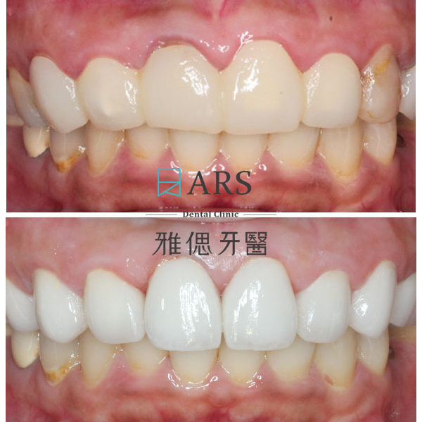 【全瓷冠+水雷射牙冠增長術】 案例1 – 蔡昀蓉醫師、陳映瑜醫師聯合主治