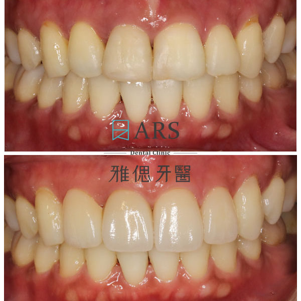 【全瓷冠+陶瓷貼片】 案例11 – 鄭聖達醫師