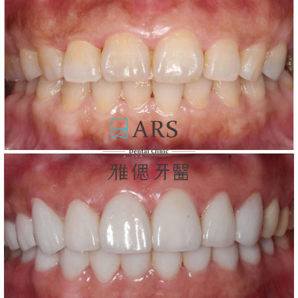 【全瓷冠+陶瓷貼片+水雷射牙冠增長術】 案例5 – 鄭聖達醫師
