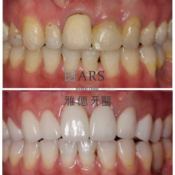 【全瓷冠+陶瓷貼片+水雷射牙冠增長術】 案例6 – 鄭聖達醫師