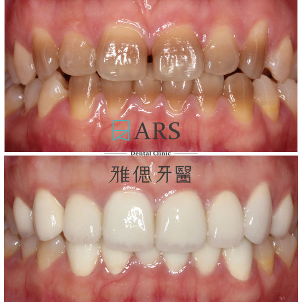 【陶瓷貼片】 案例2 – 蔡昀蓉醫師