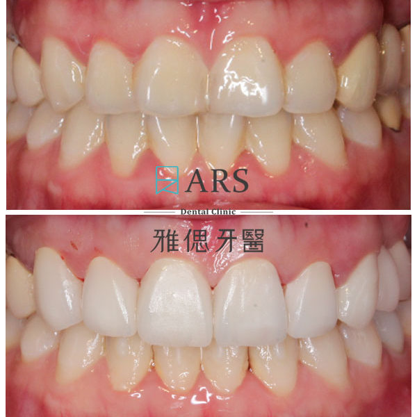 【陶瓷貼片】 案例3 – 鄭聖達醫師