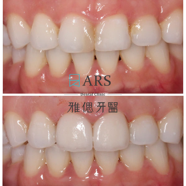 【陶瓷貼片】 案例3 – 蔡昀蓉醫師