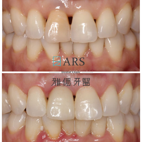 【全瓷冠】 案例13 – 蔡昀蓉醫師