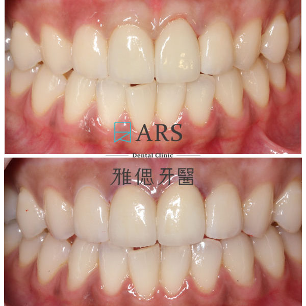 【全瓷冠】 案例14 – 蔡昀蓉醫師