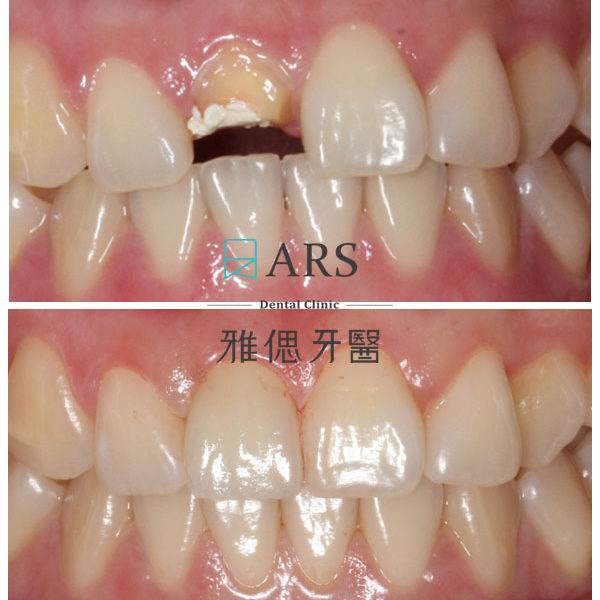 【全瓷冠】 案例5 – 鄭聖達醫師