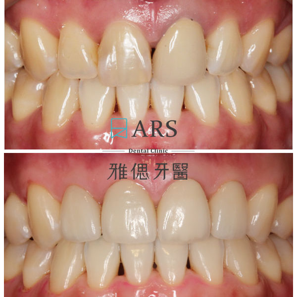 【全瓷冠】 案例6 – 鄭聖達醫師