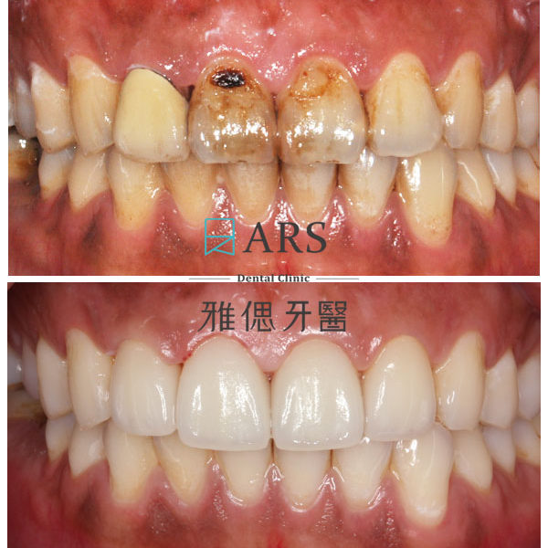 【全瓷冠】 案例7 – 鄭聖達醫師