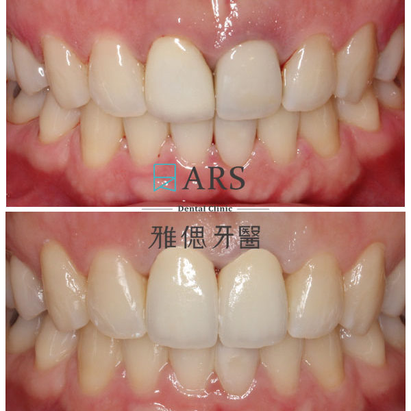 【全瓷冠+水雷射牙冠增長術】 案例4 – 鄭聖達醫師、蔡昀蓉醫師聯合主治