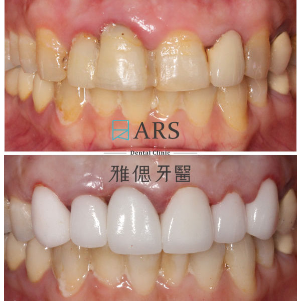 【全瓷冠+水雷射牙冠增長術】 案例5 – 鄭聖達醫師、蔡昀蓉醫師聯合主治