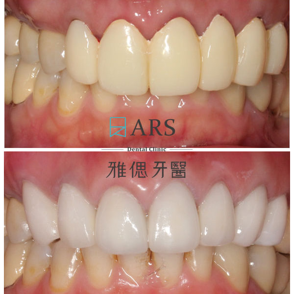 【全瓷冠+水雷射牙冠增長術】 案例6 – 鄭聖達醫師、蔡昀蓉醫師聯合主治