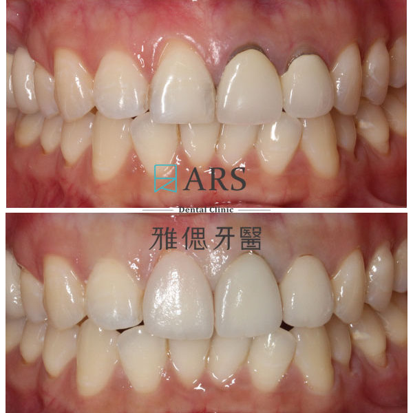 【全瓷冠+陶瓷貼片】 案例15 – 蔡昀蓉醫師