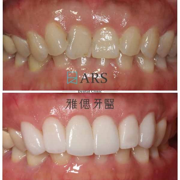 【全瓷冠+陶瓷貼片+水雷射牙冠增長術】 案例2 – 鄭聖達醫師、蔡昀蓉醫師聯合主治
