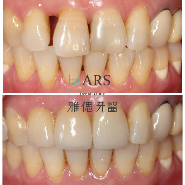 【陶瓷貼片】 案例4 – 蔡昀蓉醫師