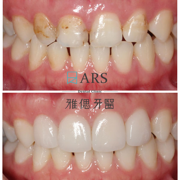 【陶瓷貼片】 案例5 – 蔡昀蓉醫師