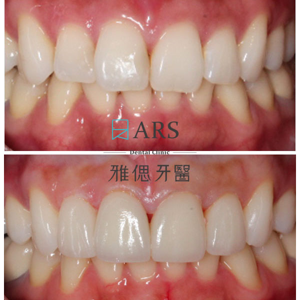 【陶瓷貼片】 案例5 – 鄭聖達醫師