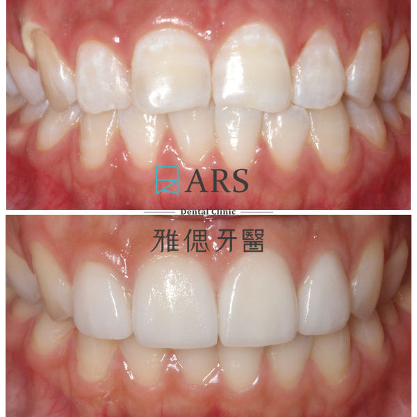 【陶瓷貼片】 案例6 – 蔡昀蓉醫師