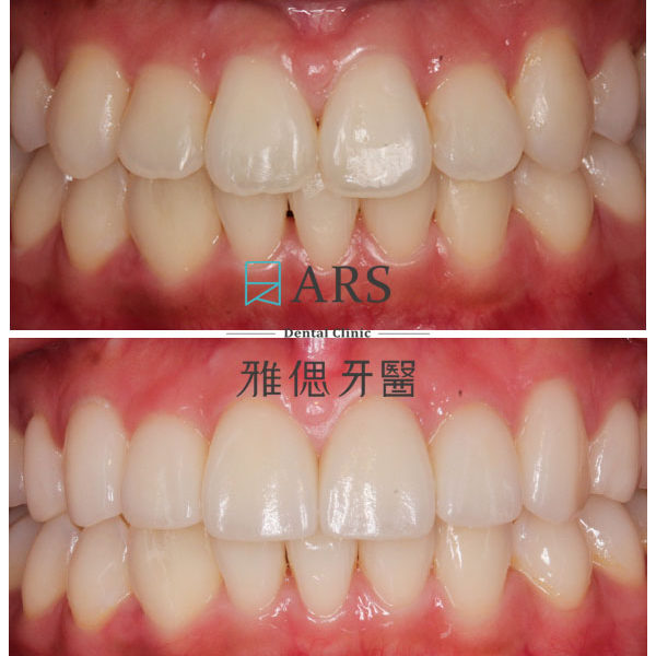 【陶瓷貼片】 案例7 – 鄭聖達醫師