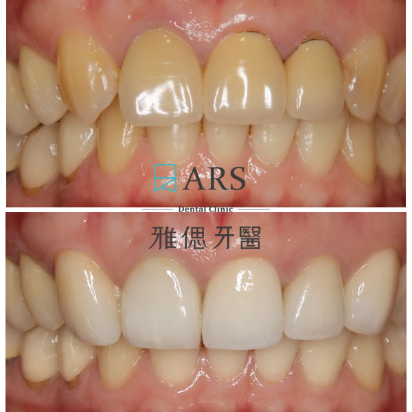 【全瓷冠】 案例10 – 鄭聖達醫師