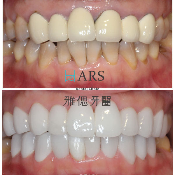 【全瓷冠】 案例15 – 蔡昀蓉醫師