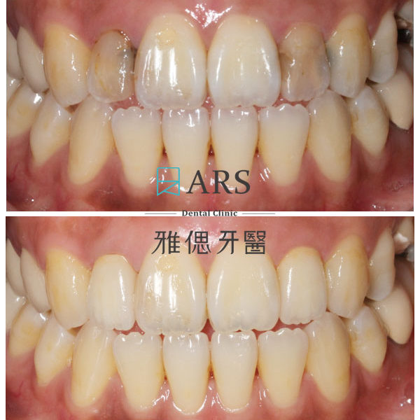 【全瓷冠】 案例16 – 蔡昀蓉醫師