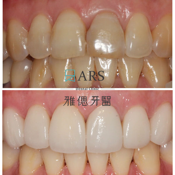 【全瓷冠】 案例8 – 鄭聖達醫師