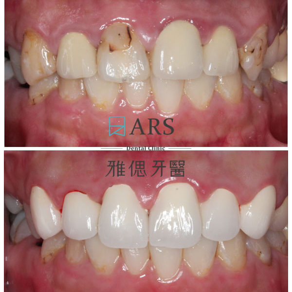 【全瓷冠】 案例9 – 鄭聖達醫師